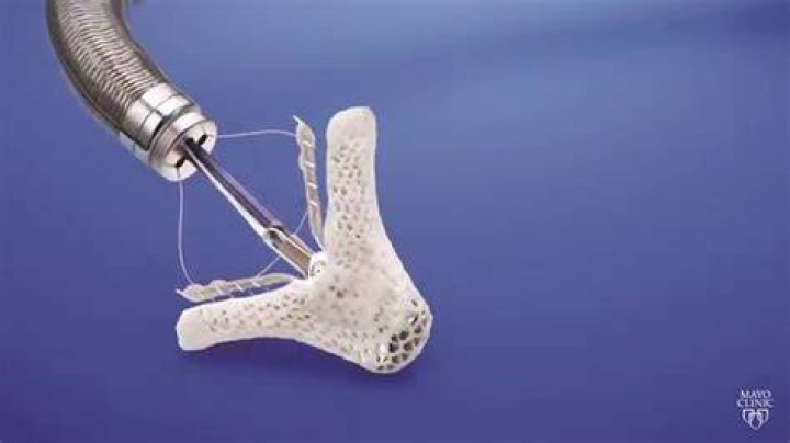 What is a mitral valve clip?