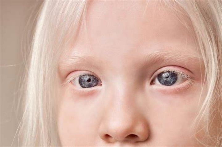 Why do albinos have red eyes?